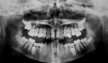 Новый биоматериал умеет восстанавливать поврежденный зуб