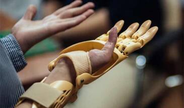 24-летней девушке установили активный протез, разработанный в Сколково [видео]
