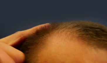 Современное лечение выпадения волос